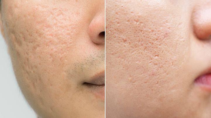 how-to-remove-acne-scars-and-regain-your-confidence-04-boxcar-ice-pick-scars-722x406